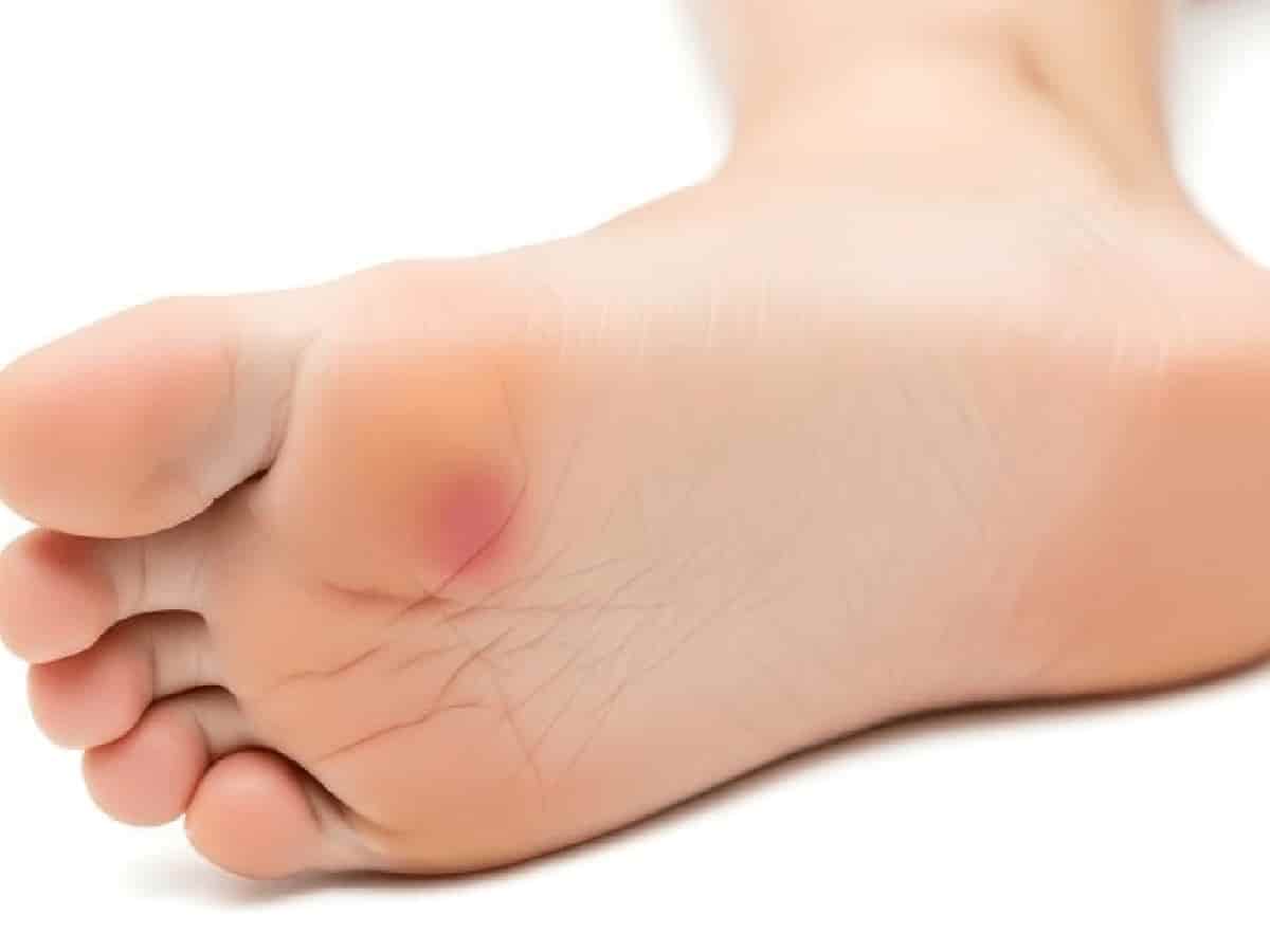 The 'Break-In' Trap: Why Squeezing Into Tight Shoes Causes Corns, Blisters, and Knee Strain