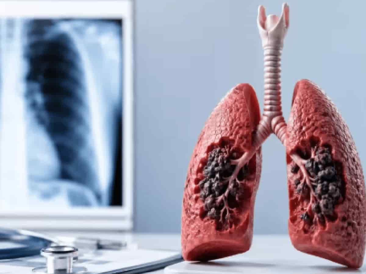 Quit Smoking but Still at Risk, Why Doctors Recommend Low-Dose CT Lung Scans
