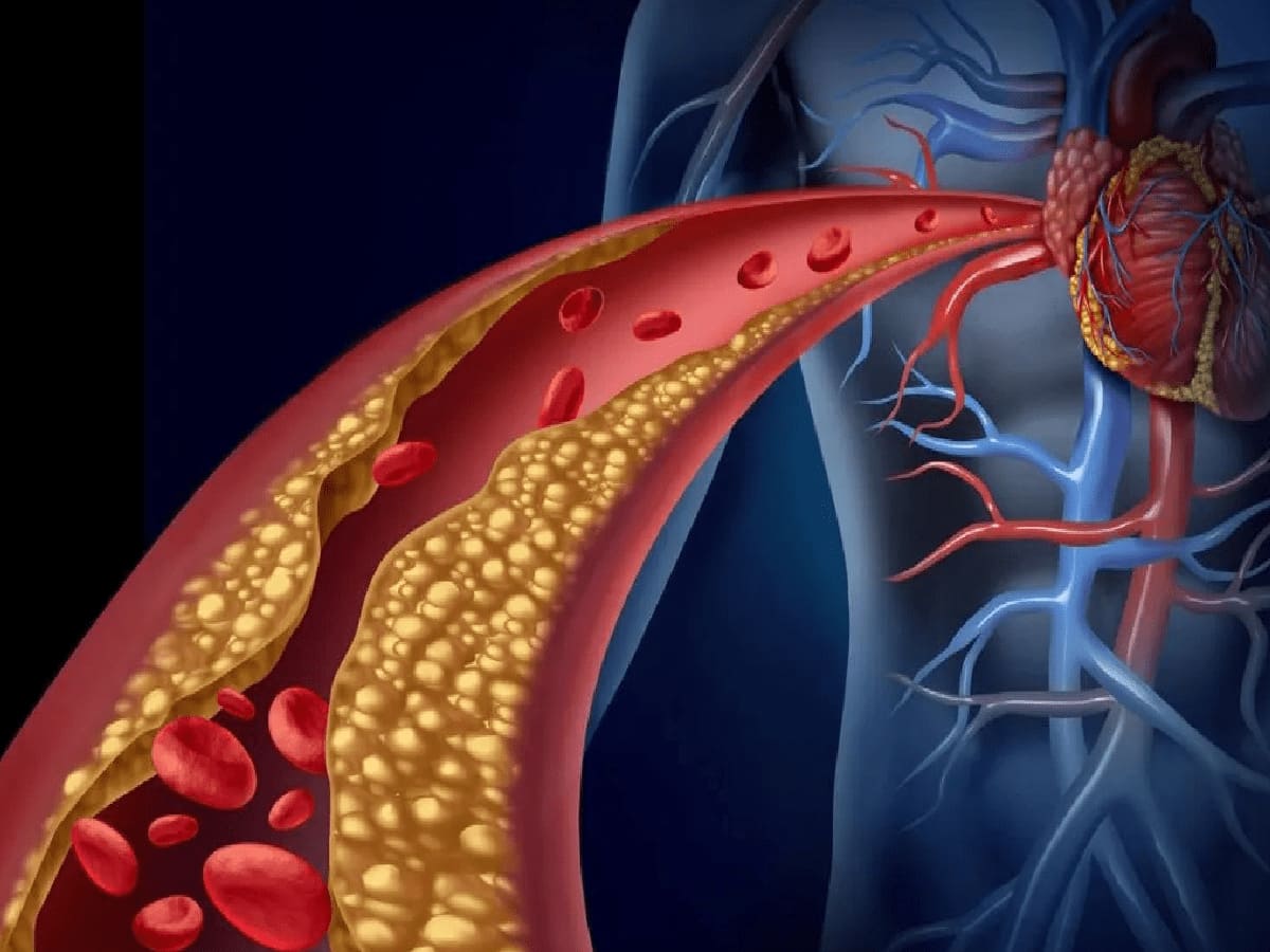 Heart Attacks with Normal Cholesterol, Dr.Reveals the Hidden Triggers